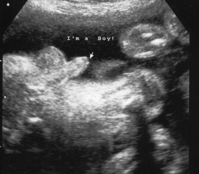 Morning sickness and gender, boy ultrasound